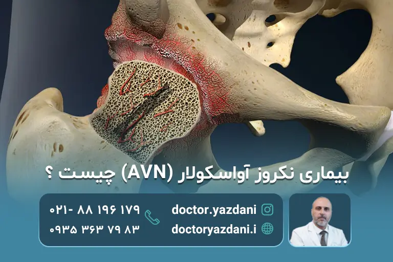 بیماری نکروز آواسکولار (AVN) چیست + علائم و بهترین روش درمانی